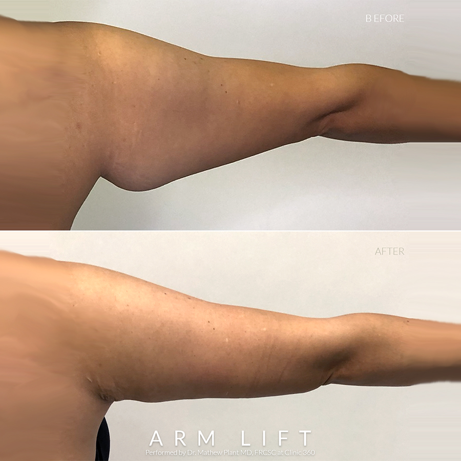 Body contouring Procedures - Arm Lift