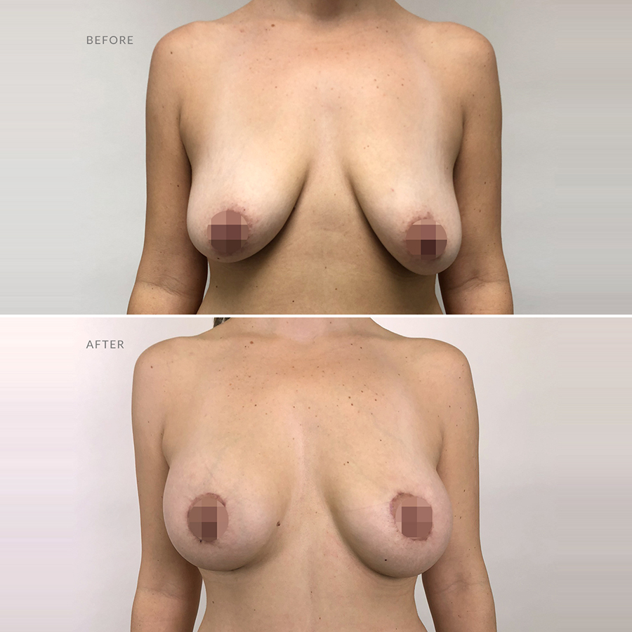 Body contouring Procedures - breast-lift-mastopexy