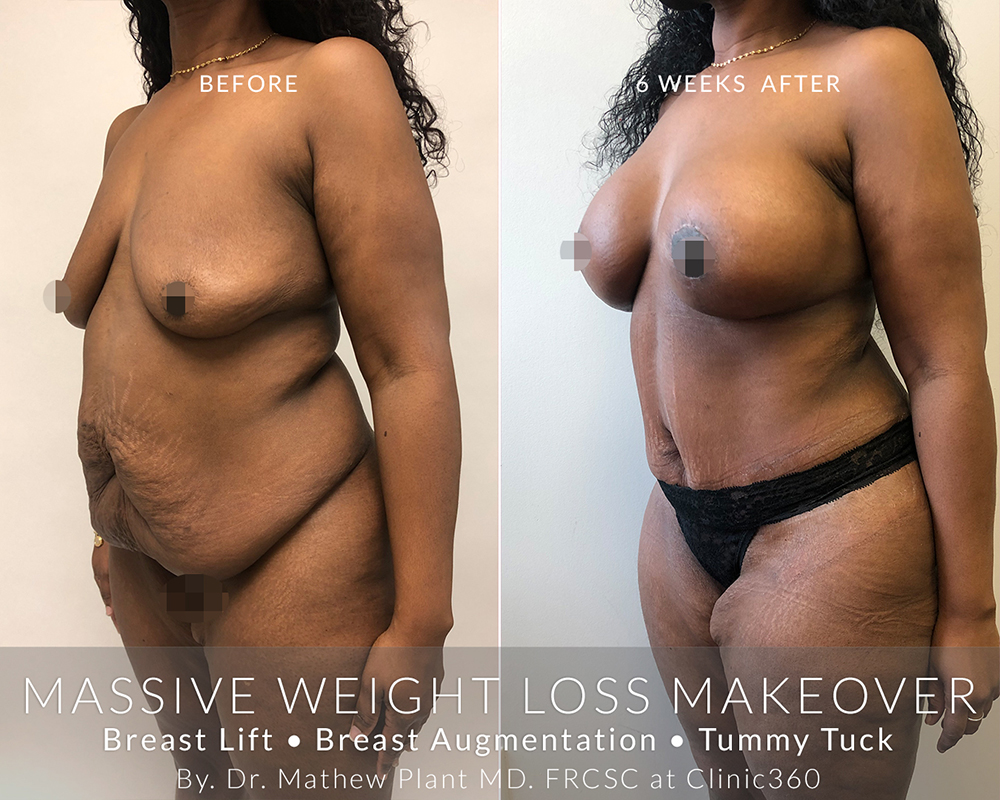 360-sleeve-clinic-post-op-surgeries-massive-weight-loss-mommy-makeover-02
