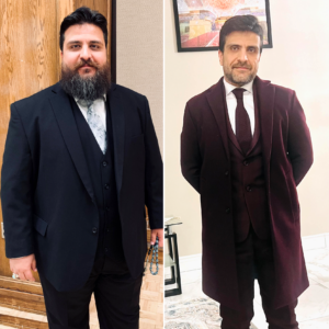 360 Sleeve- Gastric Sleeve Before and After