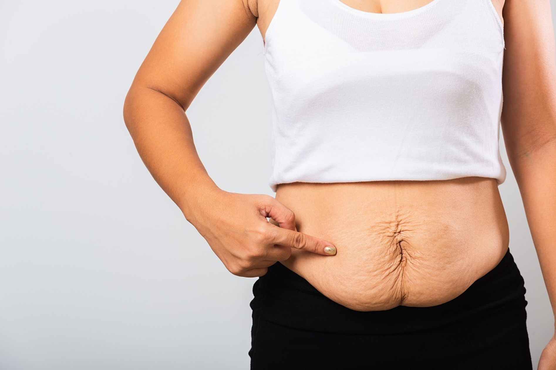Excess skin problems among adolescents after bariatric surgery