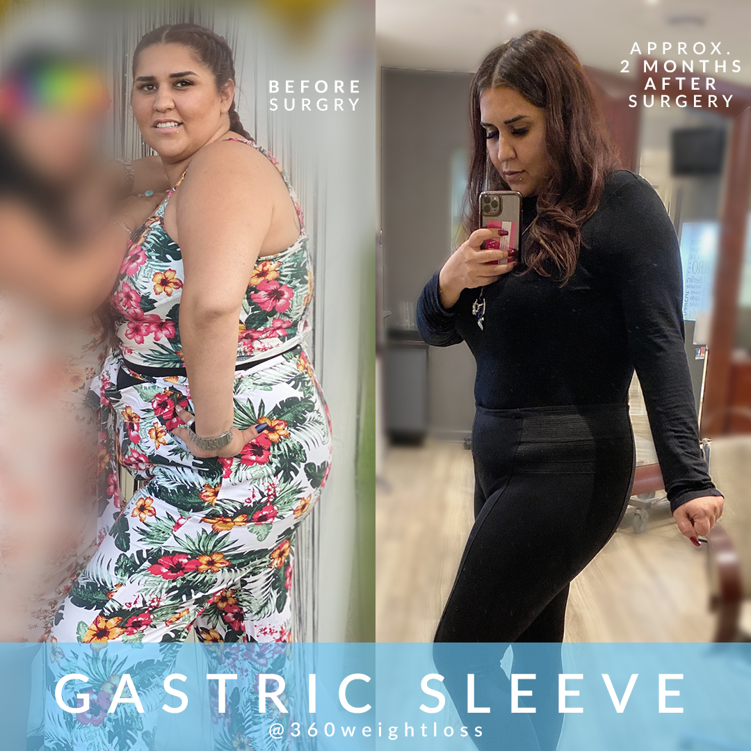 Before and After Gastric Sleeve Photos - 360 Sleeve Clinic