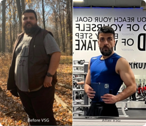 The Truth About Loose Skin After Weight Loss Surgery: My Personal Journey