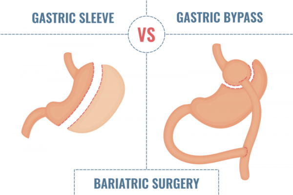 gastric bypass vs gastric sleeve